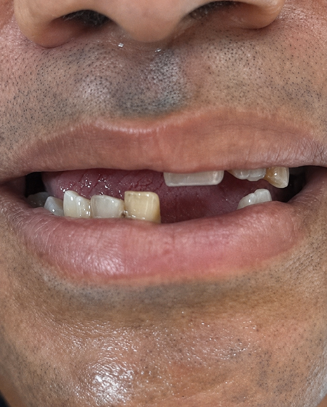 Sorriso no início do tratamento