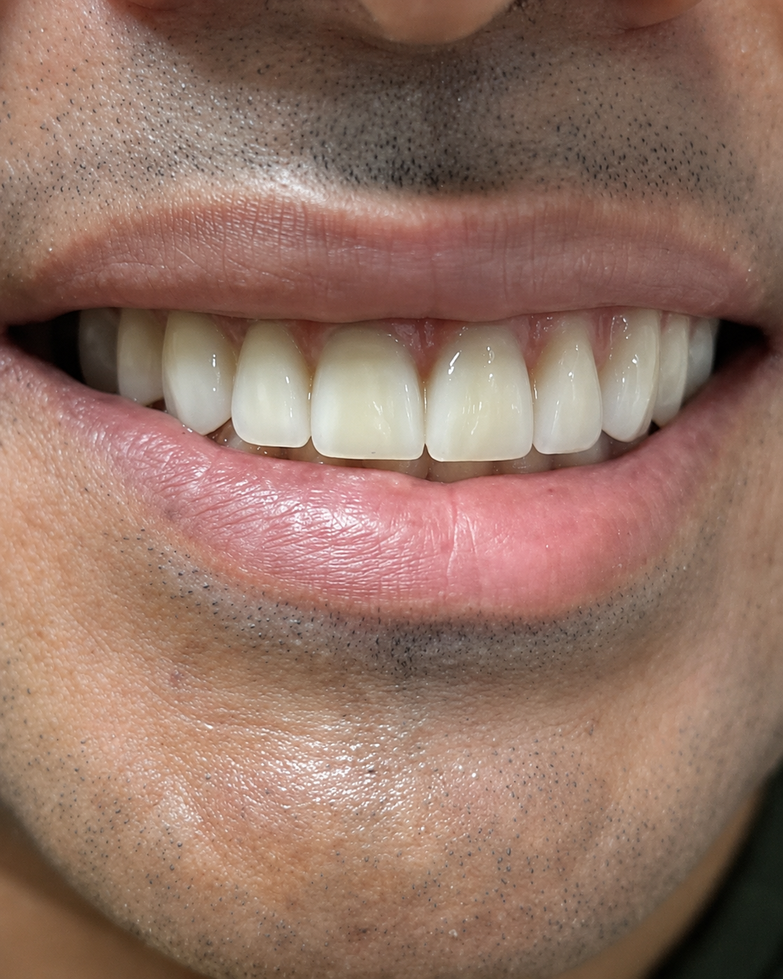 Sorriso ao final do tratamento